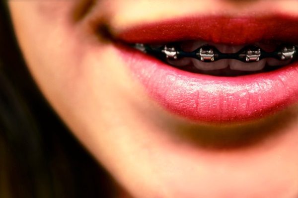 ¿Puedes unirte al ejército con aparatos ortopédicos?