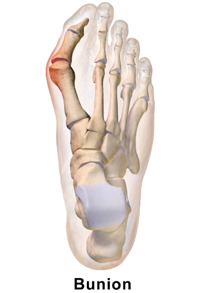 ¿Puedes unirte al ejército con juanetes?