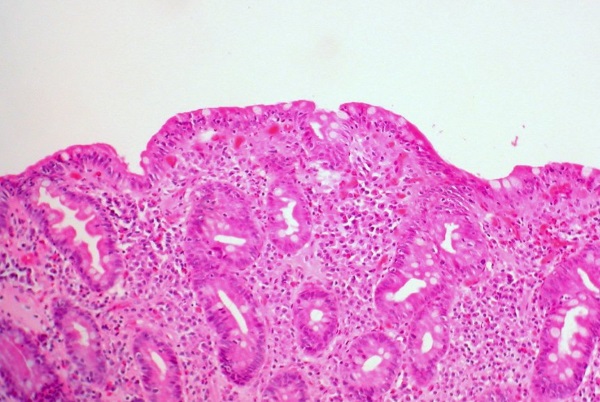 ¿Puedes unirte al ejército con la enfermedad celíaca?