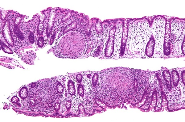 ¿Puedes unirte al ejército con la enfermedad de Crohn?