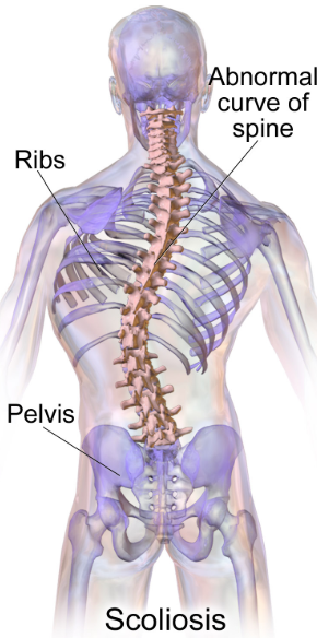 ¿Puedes unirte al ejército con escoliosis?