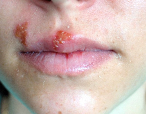 ¿Puedes unirte al ejército con herpes?